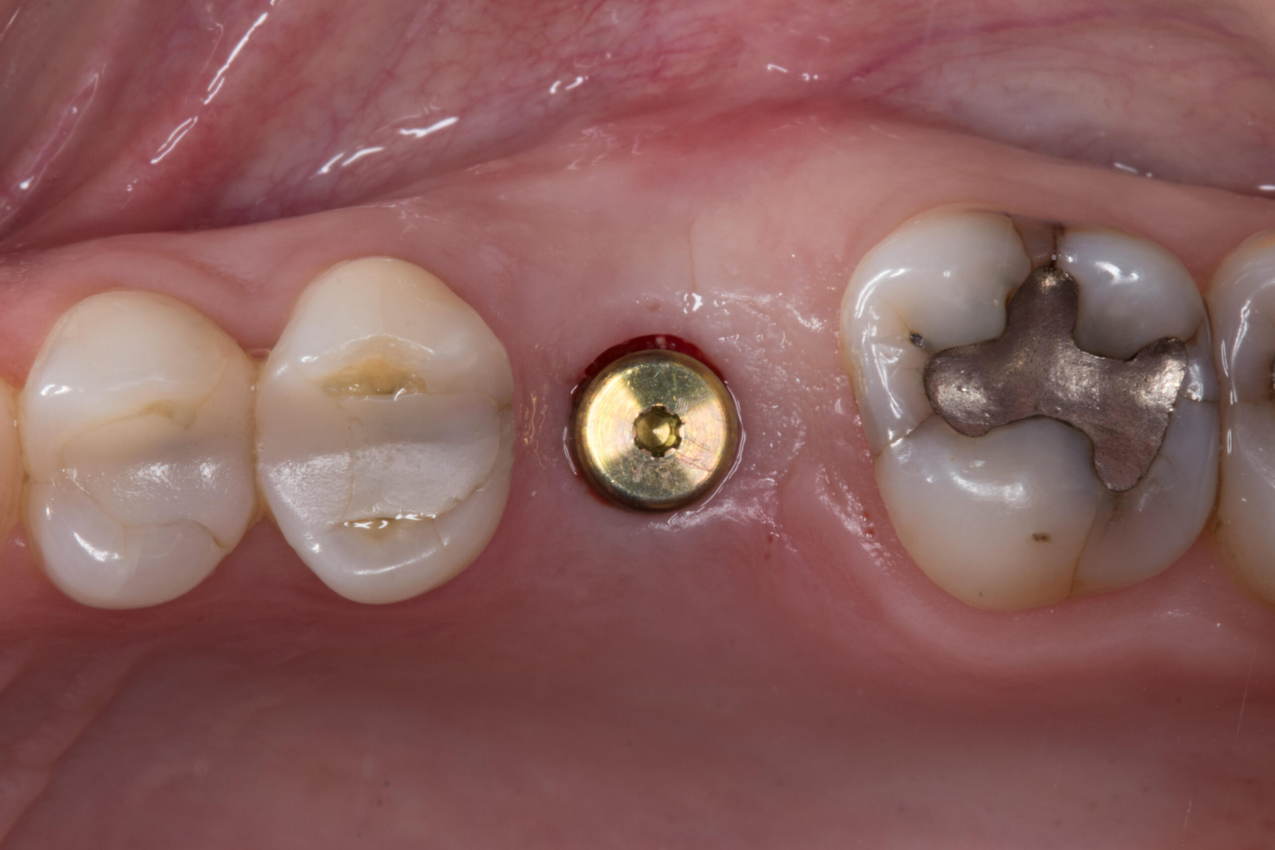 Implantes Dentales Marbella