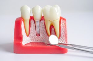 Todo lo que necesitas saber sobre los implantes dentales